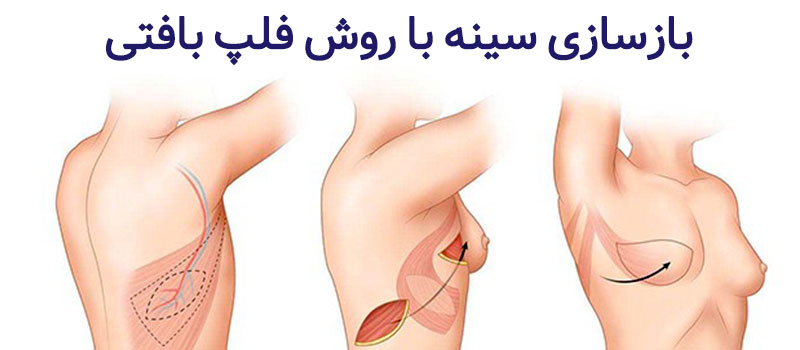 بازسازی سینه با روش فلپ بافتی