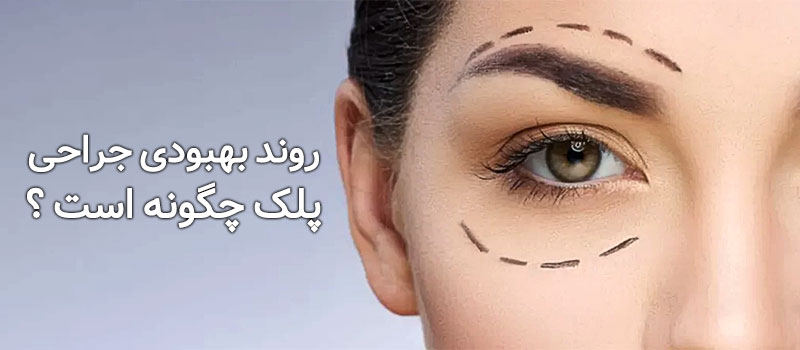 روند بهبودی جراحی پلک چگونه است ؟